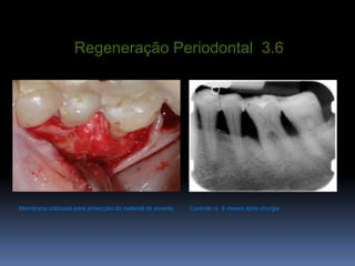 Regeneração Periodontal  3.6Membranacolocadaparaprotecção do material de enxertoControlerx  6 mesesapóscirurgia