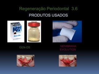 Regeneração Periodontal  3.6PRODUTOS USADOSMEMBRANAEVOLUTIONGEN-OS