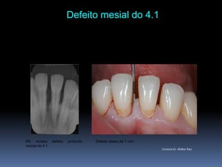 Defeito mesial do 4.1 RX mostradefeitoprofundomesialdo 4.1.Defeitoósseo de 7 mmCortesia Dr. WalterRao