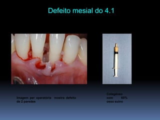 Defeito mesial do 4.1 Colagéneo com 60% ossosuinoImagem per operatóriamostradefeito de 2 paredes