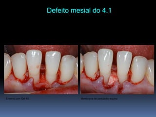 Defeito mesial do 4.1 Membrana de pericárdioequinoEnxerto com Gel 40.