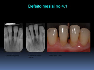 Defeito mesial no 4.1 Controle Rx pós op Bolsa com  2 mm.Controle  8 mesespós op
