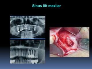  Sinus lift maxilarI