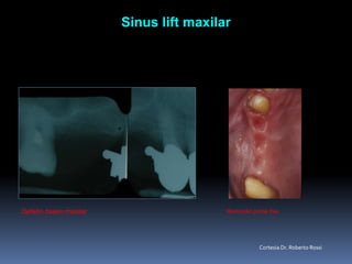Sinus lift maxilarDefeitoósseomaxilarRemoçãopontefixaCortesia Dr. Roberto Rossi