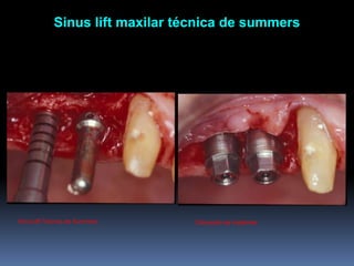 Sinus lift maxilar técnica de summersSinus lift Técnica de SummersColocação de implantes 