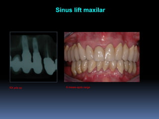  Sinus liftmaxilar8 mesesapóscargaRX pós op