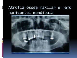 Atrofia óssea maxilar e ramo horizontal mandibula