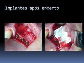 Implantes após enxerto