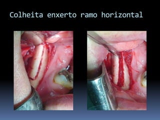 Colheita enxerto ramo horizontal