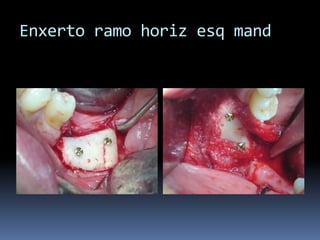 Enxerto ramo horizesqmand