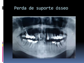   Perda de suporte ósseo