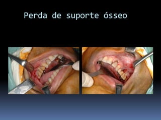   Perda de suporte ósseo