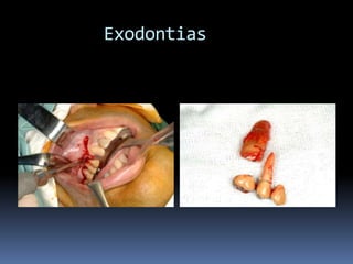 Exodontias
