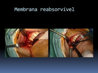    Membrana reabsorvível