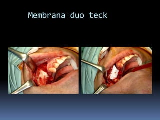     Membrana duo teck
