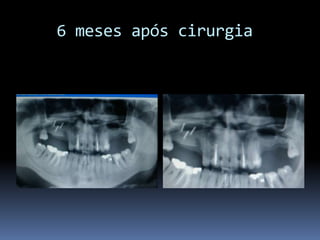     6 meses após cirurgia