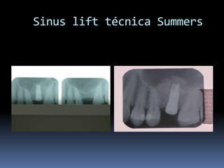 Sinuslift técnica Summers