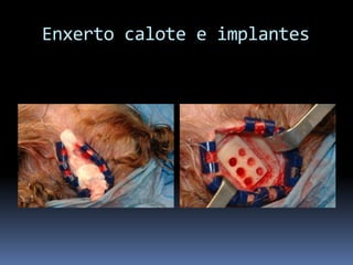   Enxerto calote e implantes