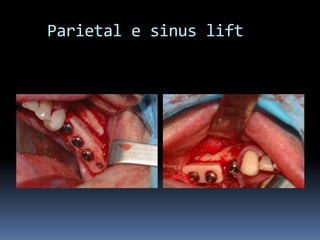    Parietal e sinuslift
