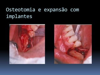 Osteotomia e expansão com     implantes