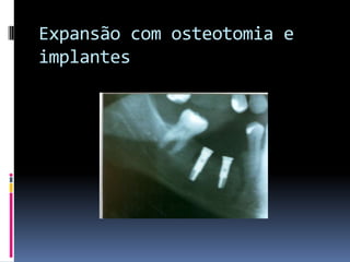 Expansão com osteotomia e implantes