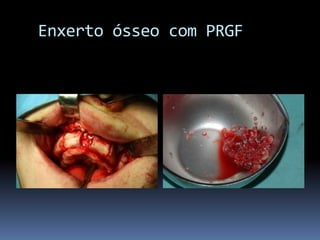   Enxerto ósseo com PRGF