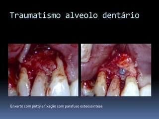 Traumatismo alveolo dentárioEnxerto com putty e fixação com parafuso osteossintese