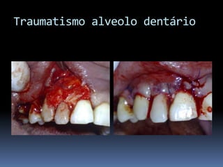 Traumatismo alveolo dentário