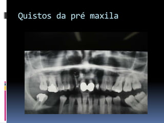 Quistos da pré maxila