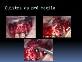 Quistos da pré maxila