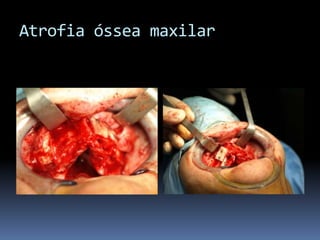 Atrofia óssea maxilar