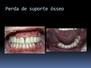 Perda de suporte ósseo