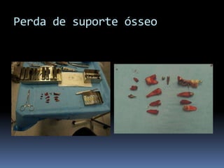 Perda de suporte ósseo