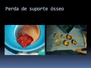 Perda de suporte ósseo