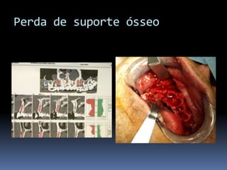 Perda de suporte ósseo