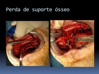 Perda de suporte ósseo