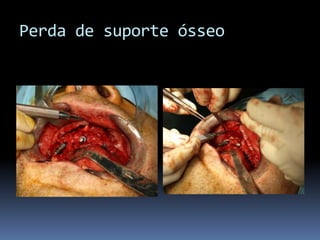 Perda de suporte ósseo