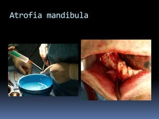 Atrofia mandibula