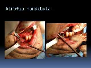 Atrofia mandibula