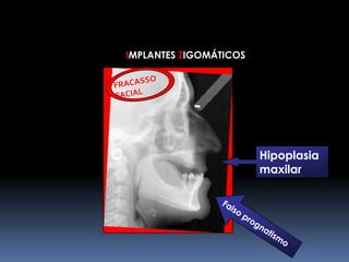 IMPLANTES ZIGOMÁTICOSFRACASSO FACIALHipoplasia maxilarFalso prognatismo