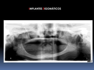 IMPLANTES ZIGOMÁTICOS