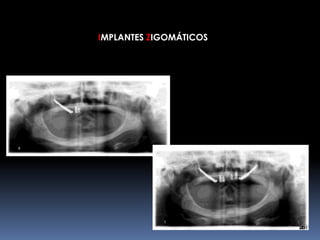IMPLANTES ZIGOMÁTICOS