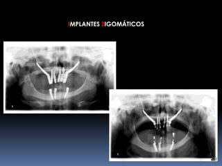 IMPLANTES ZIGOMÁTICOS