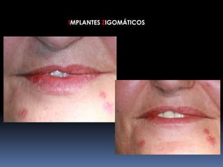 IMPLANTES ZIGOMÁTICOS