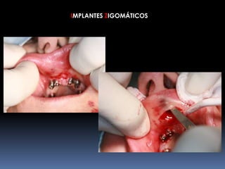 IMPLANTES ZIGOMÁTICOS