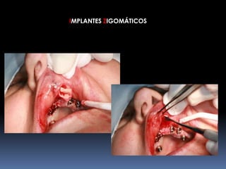 IMPLANTES ZIGOMÁTICOS