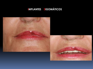 IMPLANTES ZIGOMÁTICOS