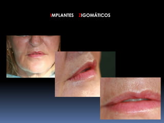 IMPLANTES ZIGOMÁTICOS