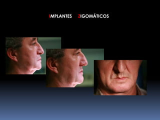 IMPLANTES ZIGOMÁTICOS