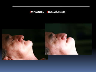 IMPLANTES ZIGOMÁTICOS